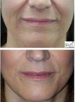 Fillers Or Botox For Dynamic Lines