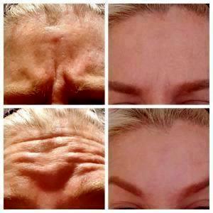 Forehead And Glabella Using Dysport By Dr. Lee E. Corbett, MD, Plastic Surgeon In Louisville, Kentucky