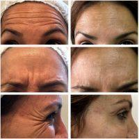 Forehead, Frown Lines, Crows Feet Botox As Preventative Treatment