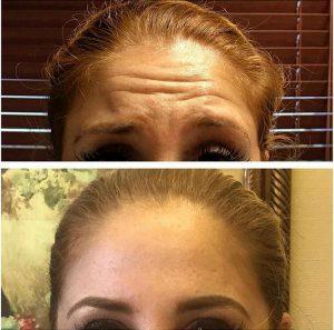 Forehead Lines Botox At Estucia Weight Loss And Aesthetics