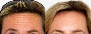 Forehead Lines Botox By Dr. Mark R. Murphy, MD, Plastic Surgeon In Palm Beach Gardens, Florida (1)