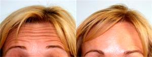 Forehead Lines Botox By Dr. Mark R. Murphy, MD, Plastic Surgeon In Palm Beach Gardens, Florida (2)