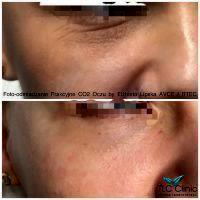 Fractional Co2 Laser For Lower Eyelid Wrinkes