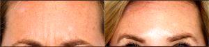 Frown Lines Botox By Dr. Mark R. Murphy, MD, Plastic Surgeon In Palm Beach Gardens, Florida (1)