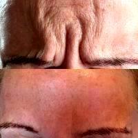 How Does Botox Work For Wrinkles