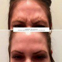 Improve The Area Between The Brows