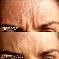 It Normally Takes 1-2 Weeks For The Full Effect Of Botox Injections To Be Visible