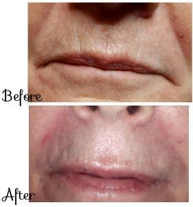 Juvederm Before And After Photos Nasolabial Folds (1)