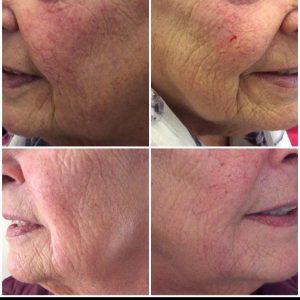 Juvederm Before And After Photos Nasolabial Folds (2)