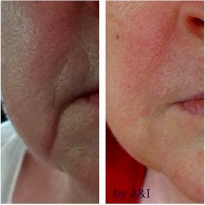 Juvederm Before And After Photos Nasolabial Folds (3)