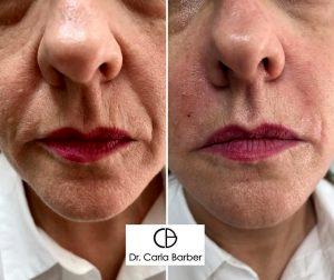 Juvederm Before And After Photos Nasolabial Folds (4)