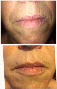 Juvederm Before And After Photos Nasolabial Folds (5)