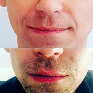 Juvederm Before And After Photos Nasolabial Folds (6)