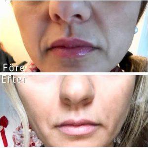 Juvederm Before And After Photos Nasolabial Folds (7)