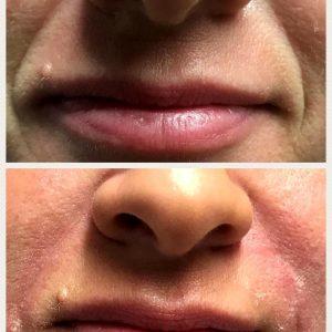 Juvederm Before And After Photos Nasolabial Folds (8)