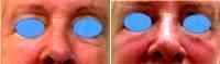 Juvederm Filler For Lower Eyelid Hollows By Dr. Bryan K. Chen, MD, San Diego Dermatologist
