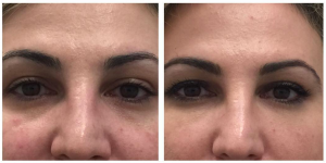 Juvederm Voluma To The Under Eye Area And Lid Cheek Junction By Anusha H. Dahanayake, NP, Doctor In Los Angeles, California