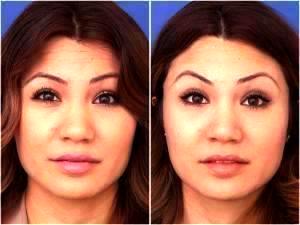 Lasky Aesthetics & Laser Cente, Medical Spa In Beverly Hills, California - Botox Forehead And Glabella (1)