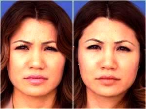 Lasky Aesthetics & Laser Cente, Medical Spa In Beverly Hills, California - Botox Forehead And Glabella (2)