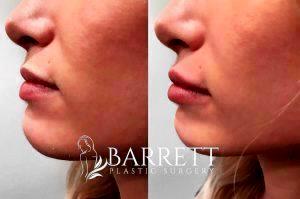 Lip Injections By Dr. Daniel Barrett, Plastic Surgeon In Beverly Hills, California
