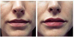 Lips Injected With Juvederm Ultra By Anusha H. Dahanayake, NP, Doctor In Los Angeles, California
