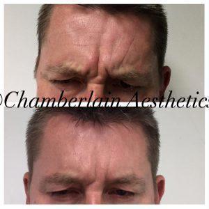 Male Botox 11 Lines