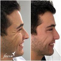 Male Botox Crows Feet Before And After Picture