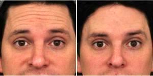Male Botox Patient Results By Dr. Todd C. Becker, MD, PhD, Boulder Dermatologist