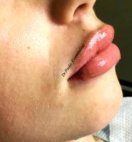 Many Women Consider Botox Injections In Lips