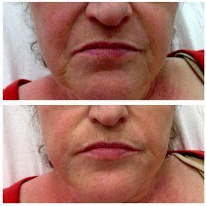 Marionette Lines Botox Before And After Pictures (1)
