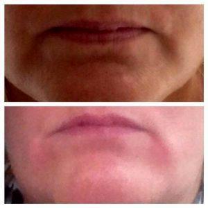 Marionette Lines Botox Before And After Pictures (2)