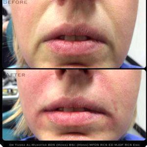 Marionette Lines Botox Before And After Pictures (3)