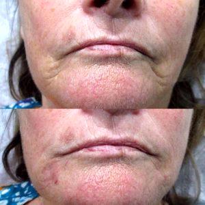 Marionette Lines Botox Before And After Pictures (4)