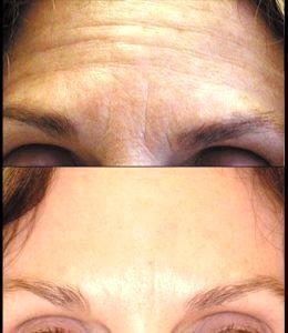 Mimic Wrinkles On Foreheaf At Gateway Aesthetic Institute And Laser Center,Salt Lake City