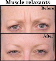 Muscle Relaxants For Frown Linews Before And After