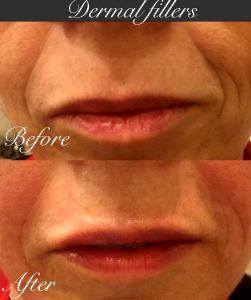 Nasolabial Fold And Fillers (1)