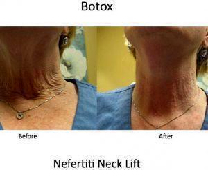 Nefertiti Neck Lift Before And After
