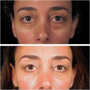 Non Surgical Blepharoplasty (under Eyes) Using Juvederm By Los Angeles Cosmetic Surgeon Dr. Alexander Rivkin