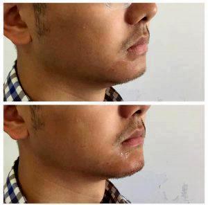 Non Surgical Chin Augmentation Radiesse By Los Angeles Cosmetic Surgeon Dr. Robert Cohen