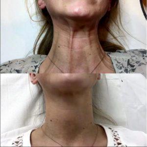 One Week Post Neck Treatment With Botulinum Toxin For Platysmal Bands