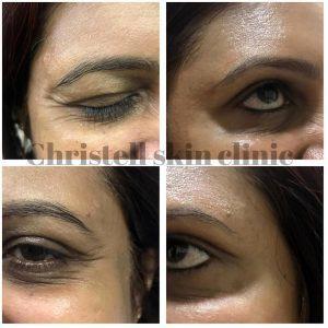 Pictures Of Botox Under Eyes (1)