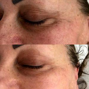 Pictures Of Botox Under Eyes (2)