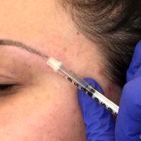Placing Botox In The Muscles That Depress The Brow