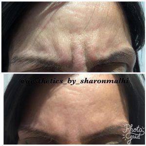 Preventative Botox 11 Lines Before And After