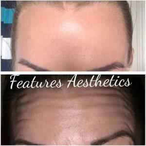 Preventative Botox Forehead Before And After