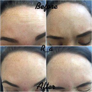 Preventative Botox Forehead Before And After Pics