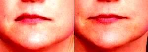 Preventative Botox To Even Out Lip Asymmetry By Dr Sirius K. Yoo, MD, San Diego Facial Plastic Surgeon