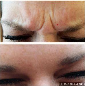 Preventative Botox Wrinkles Frown Lines
