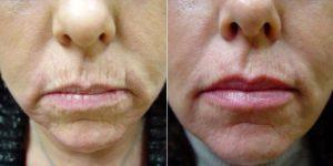 Radiesse And Restylane To Nasolabial Folds, Marionettes And Lips Results With Dr Marcus A. Jimenez, MD, FACS, Fort Wayne General Surgeon