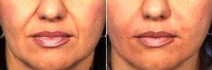 Radiesse To Smile Lines (nasolabial Folds) With Dr Grant Stevens, MD, Los Angeles Plastic Surgeon